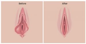 Before and After Photos of Labiaplasty Surgery in Brooklyn, Manhasset, Manhattan, NY, Greenwich, CT, Ridgefield, NJ