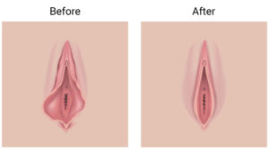 Before and after surgery diagram for Labiaplasty in Manhattan, Brooklyn, Manhasset, NYC, Greenwich, CT, Ridgefield, NJ